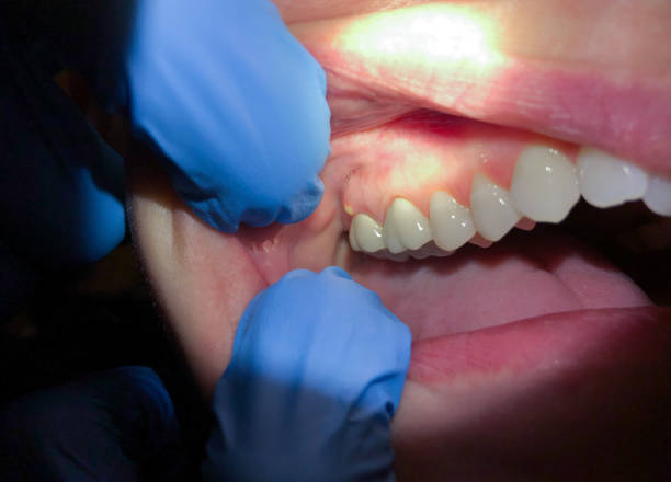 Best Emergency Wisdom Teeth Removal in Brookland, AR